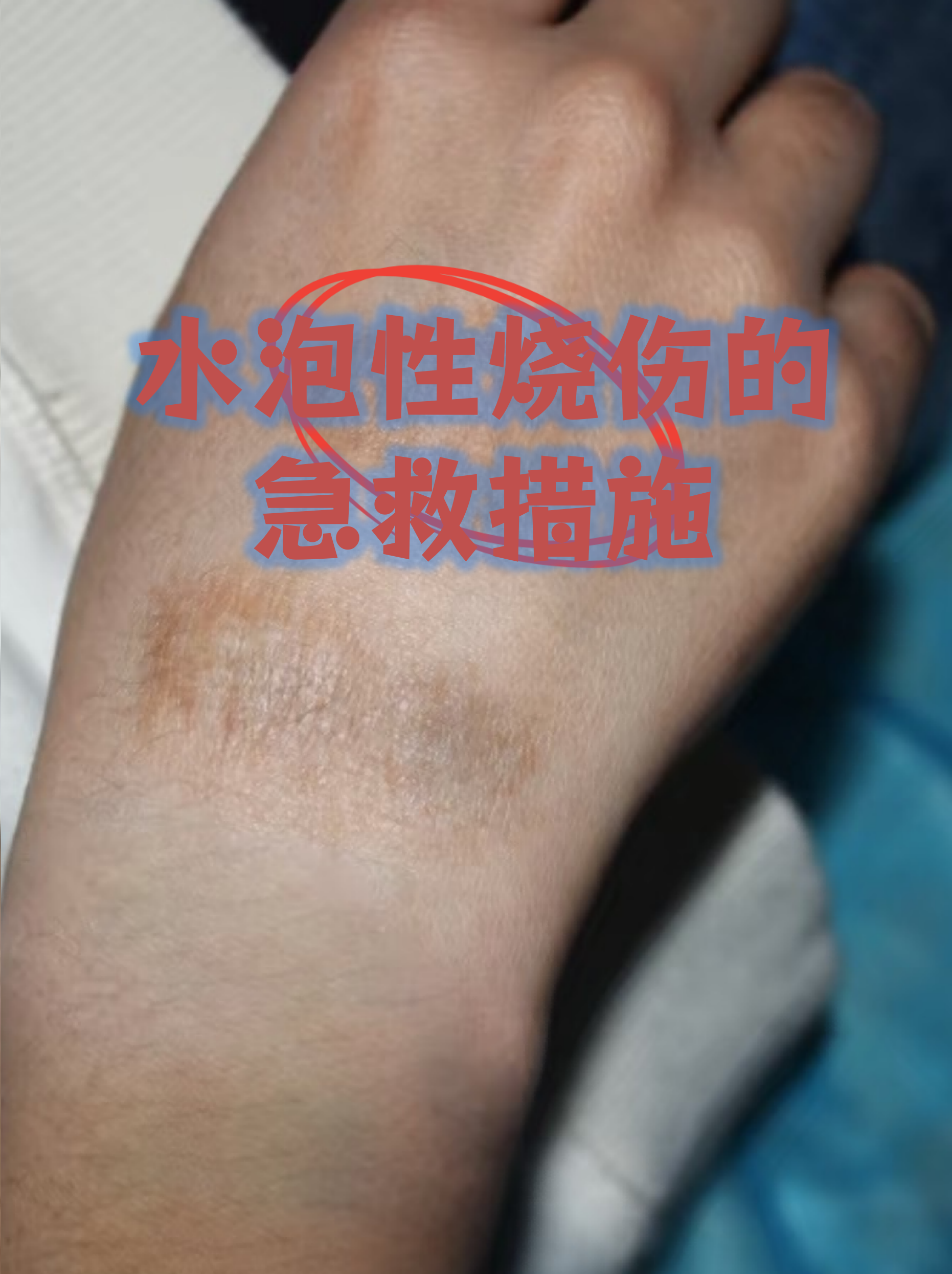 蒸汽烫伤之后怎么处理