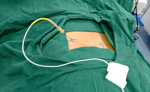 腰间盘突出做了射频治疗后感觉狠好,可出院坐了3