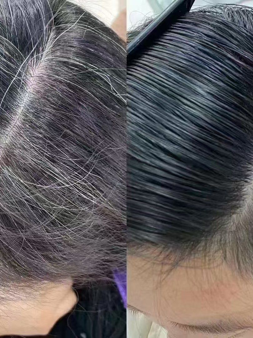 遗传性白发怎么治疗