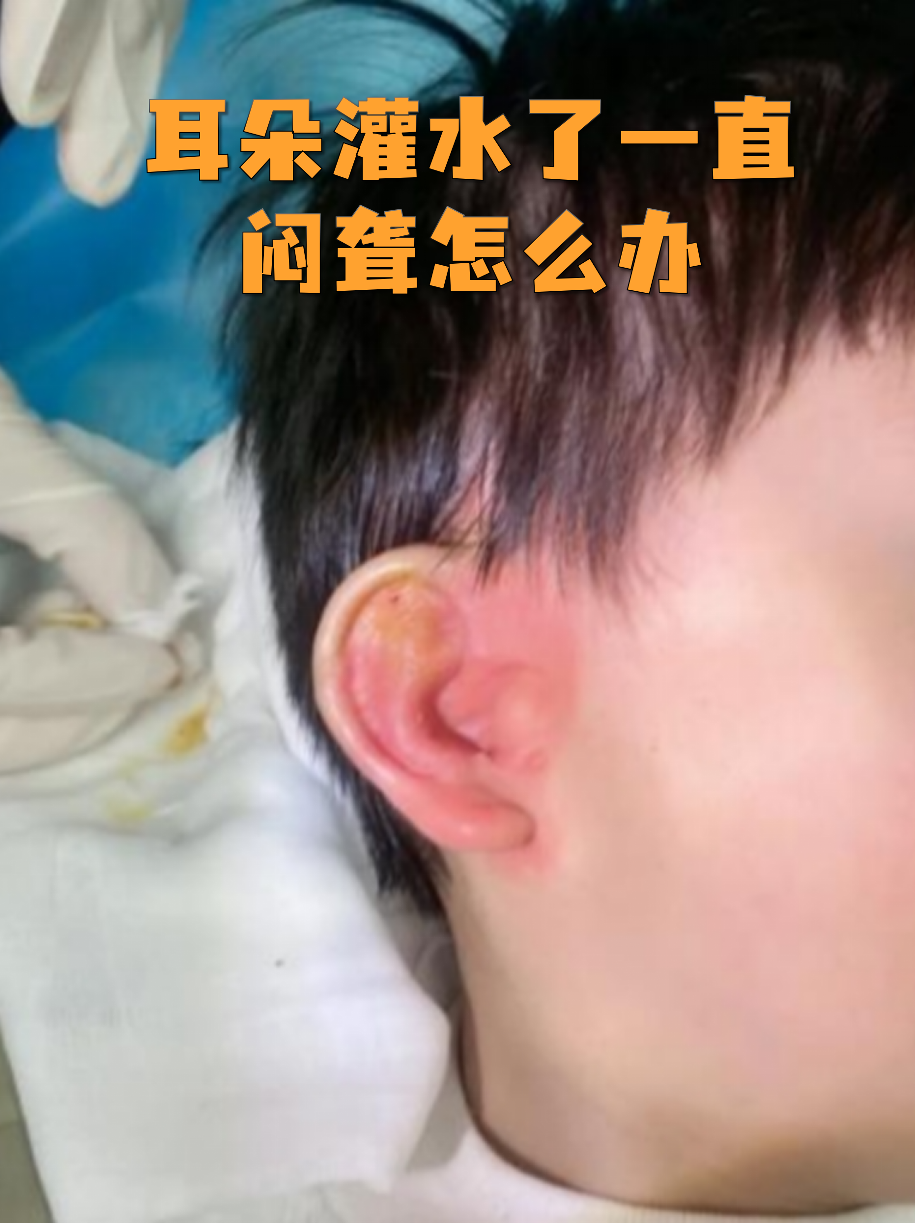 耳朵进水怎么处理