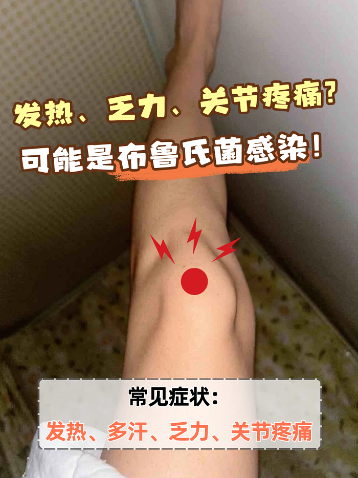 布氏杆菌病治疗方法有哪些