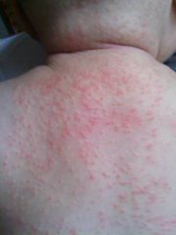 婴儿长痱子怎么办