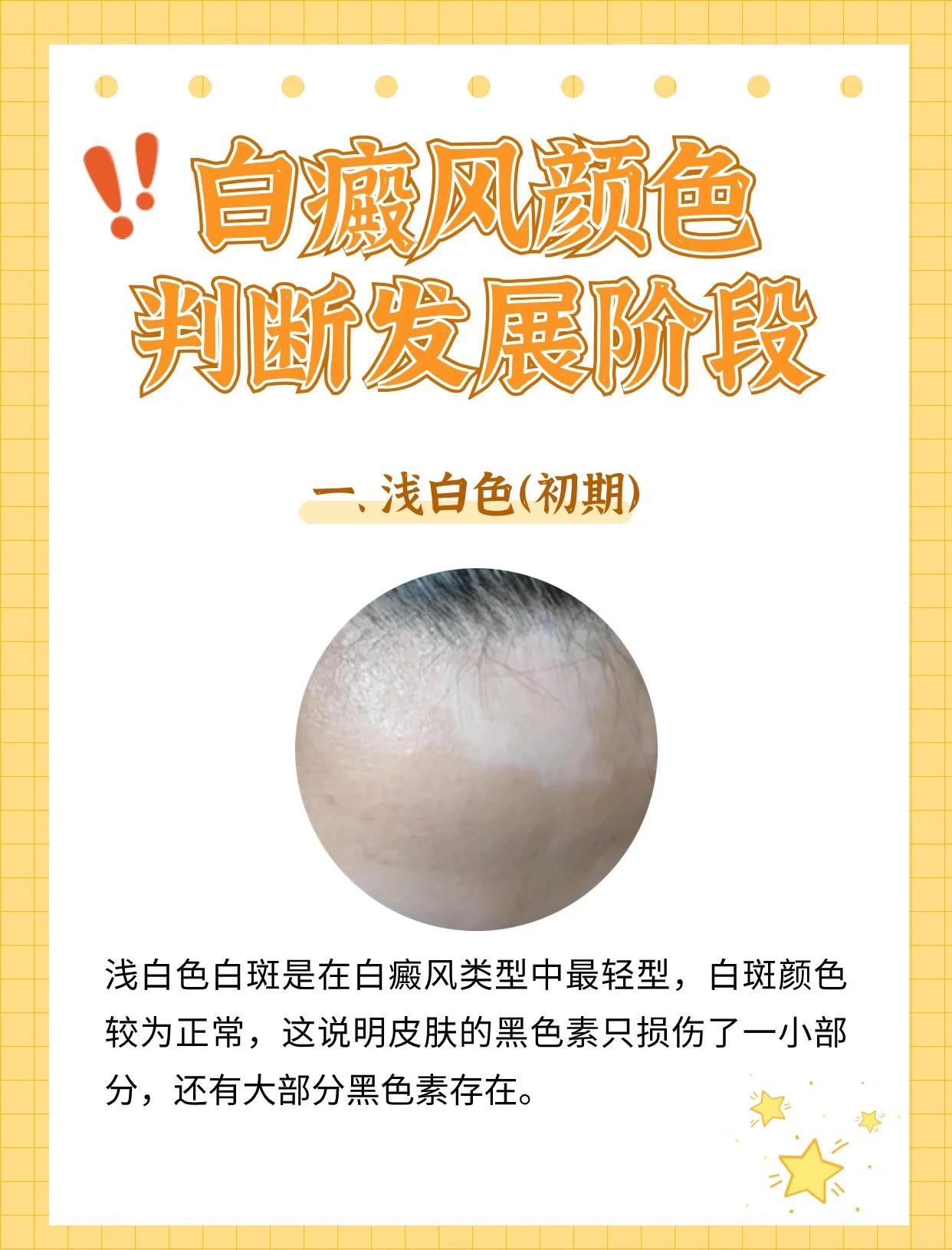 白癜风的危害严重吗