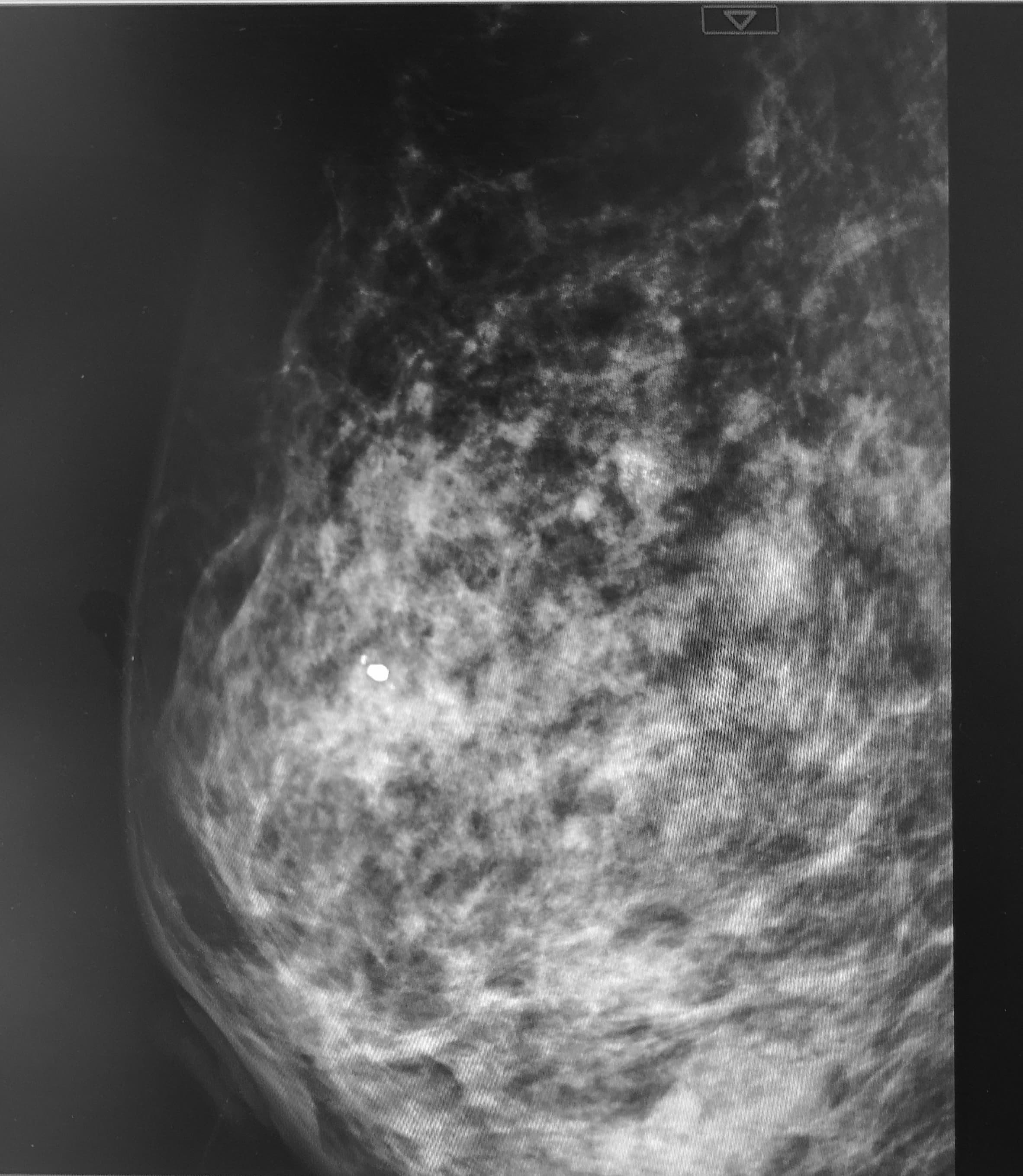 乳房钙化点可能治愈吗