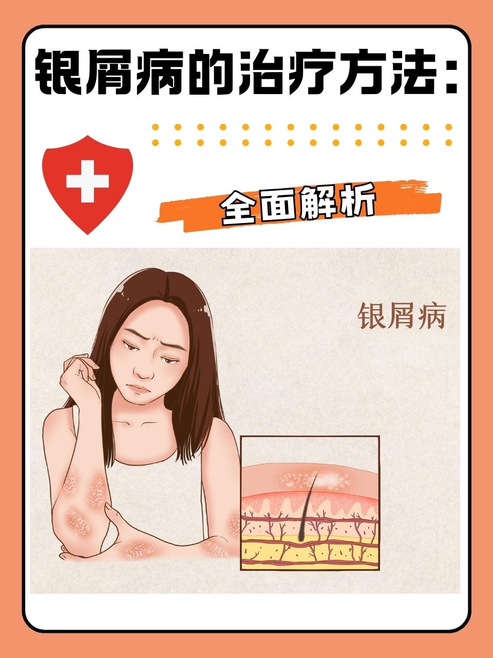 怎样治疗牛皮癣?