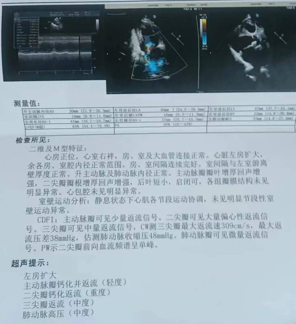 二尖瓣狭窄心脏听诊有什么变化?