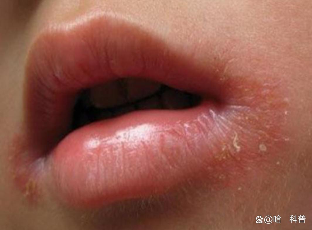 下嘴唇脱皮怎么办