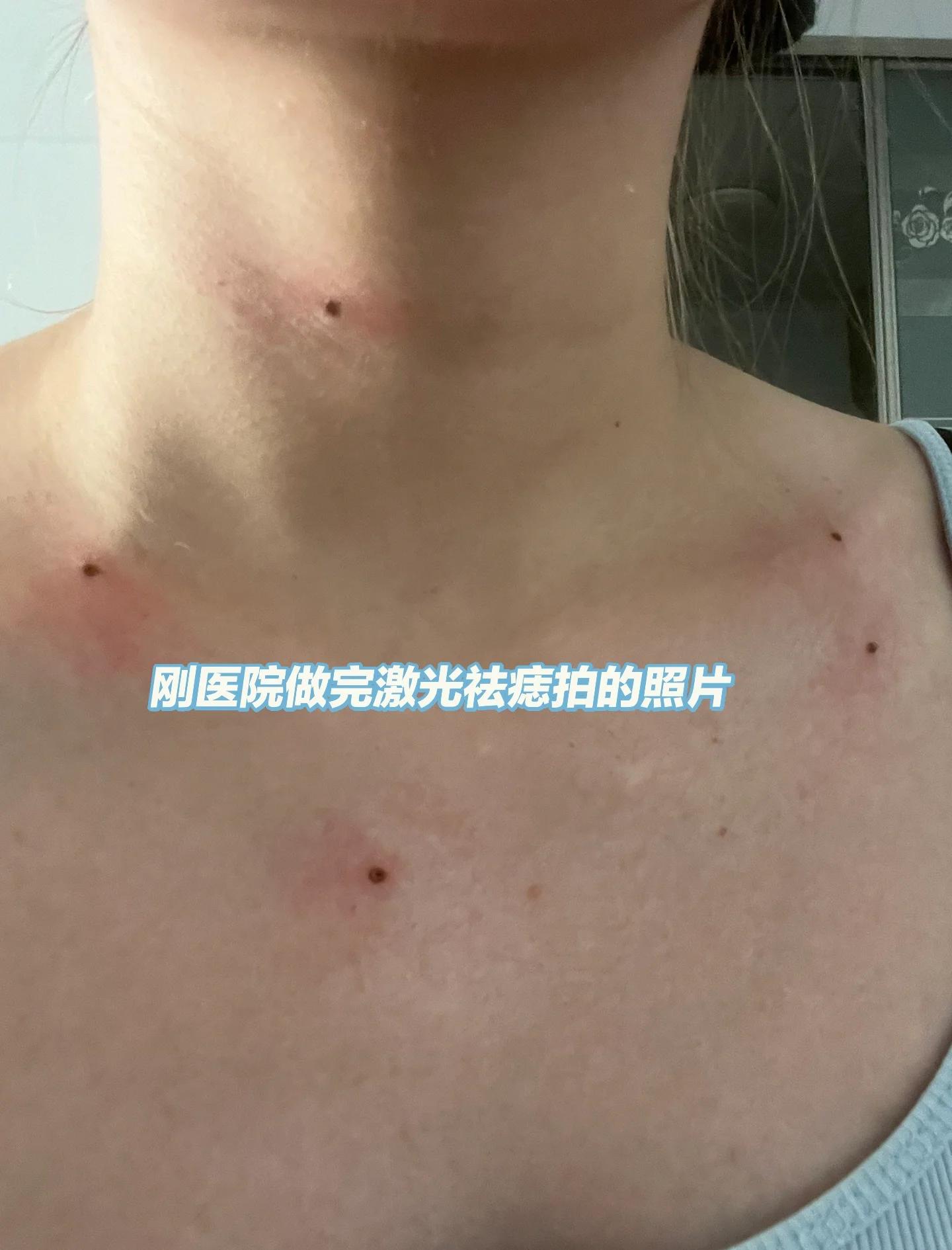 用醋精面粉去痦子现在变成这样