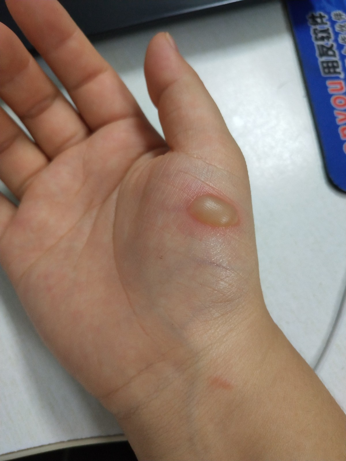 被油烫伤起泡怎么办,泡需要挑破吗?谢谢!