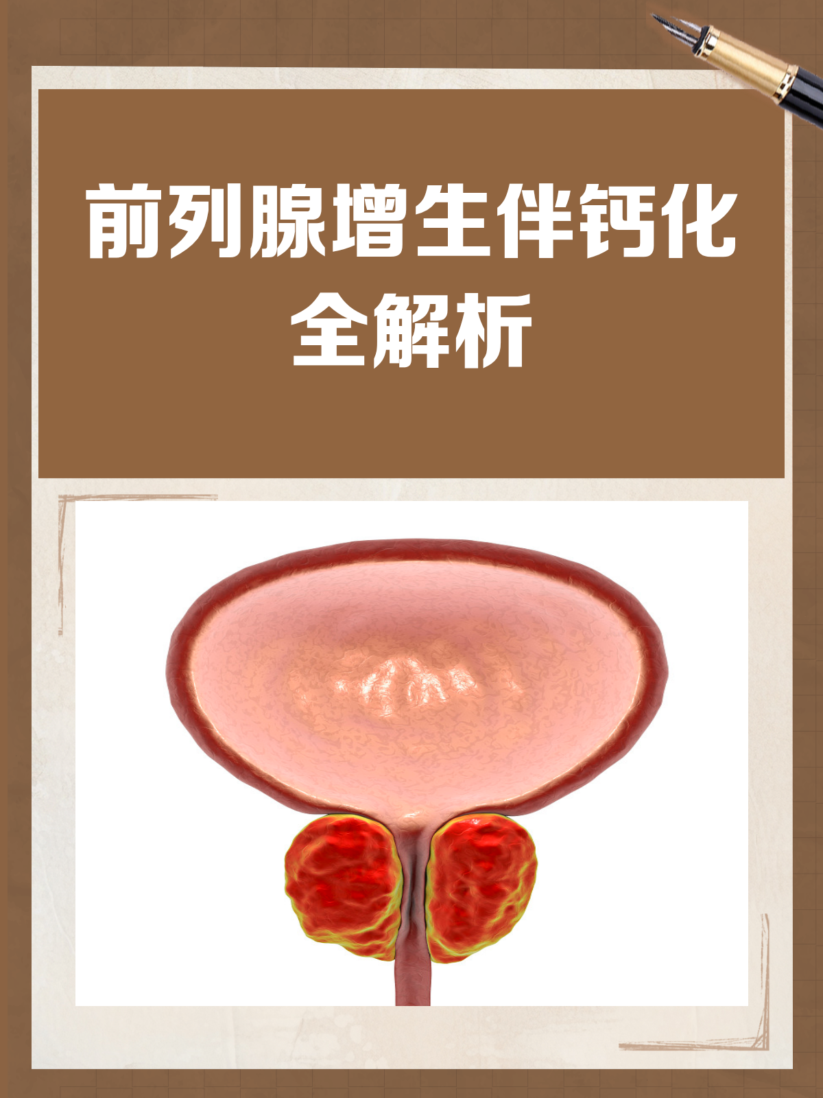 前列腺增生伴钙化是什么意思?