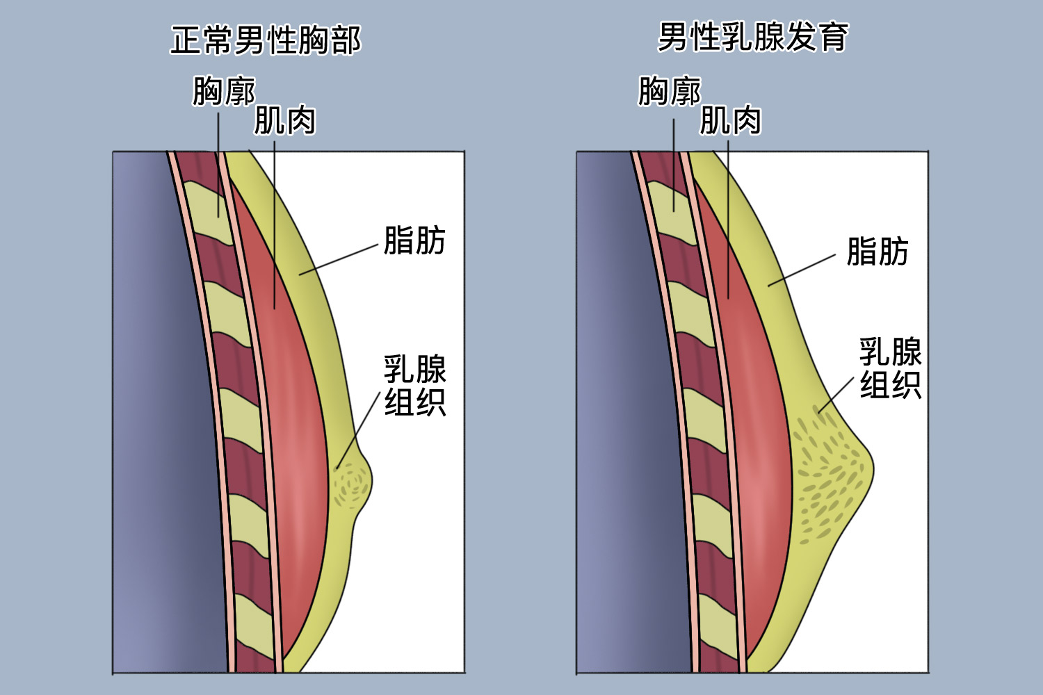 男人乳腺增生怎么办