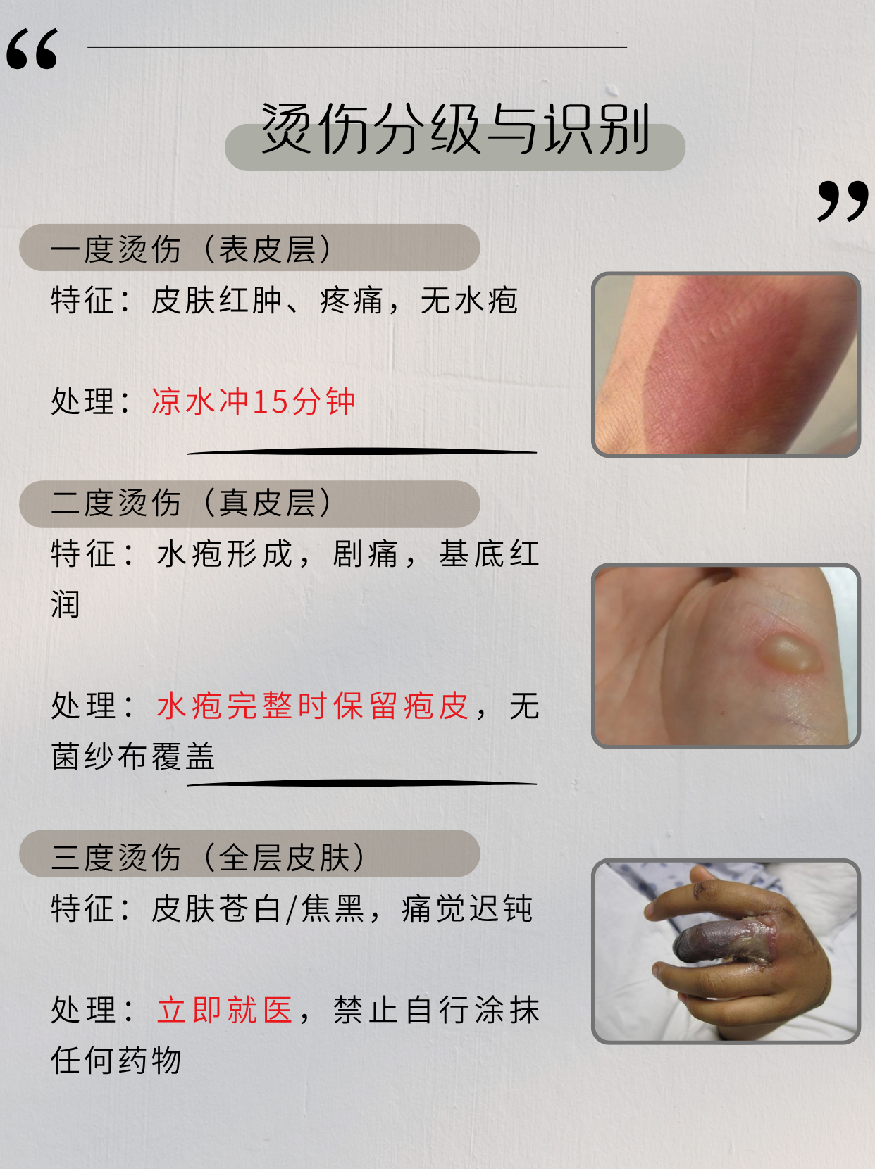 高温油烫伤后怎么处理