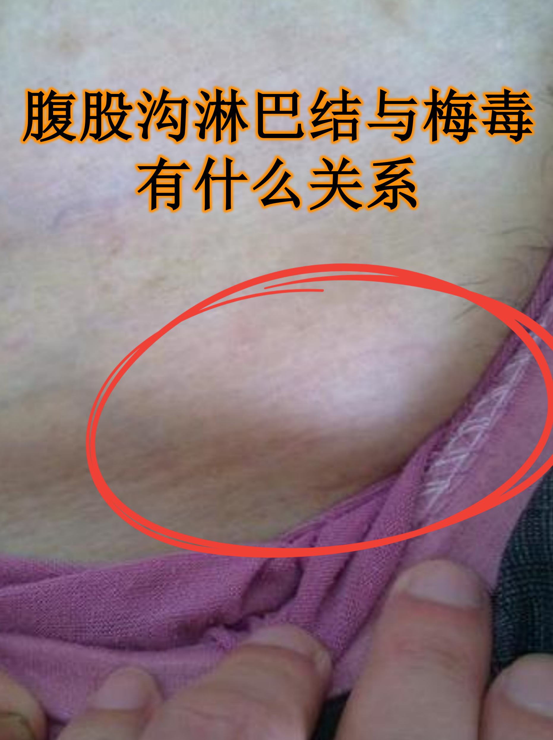 腹部淋巴结肿大