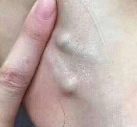 腹部淋巴结肿大