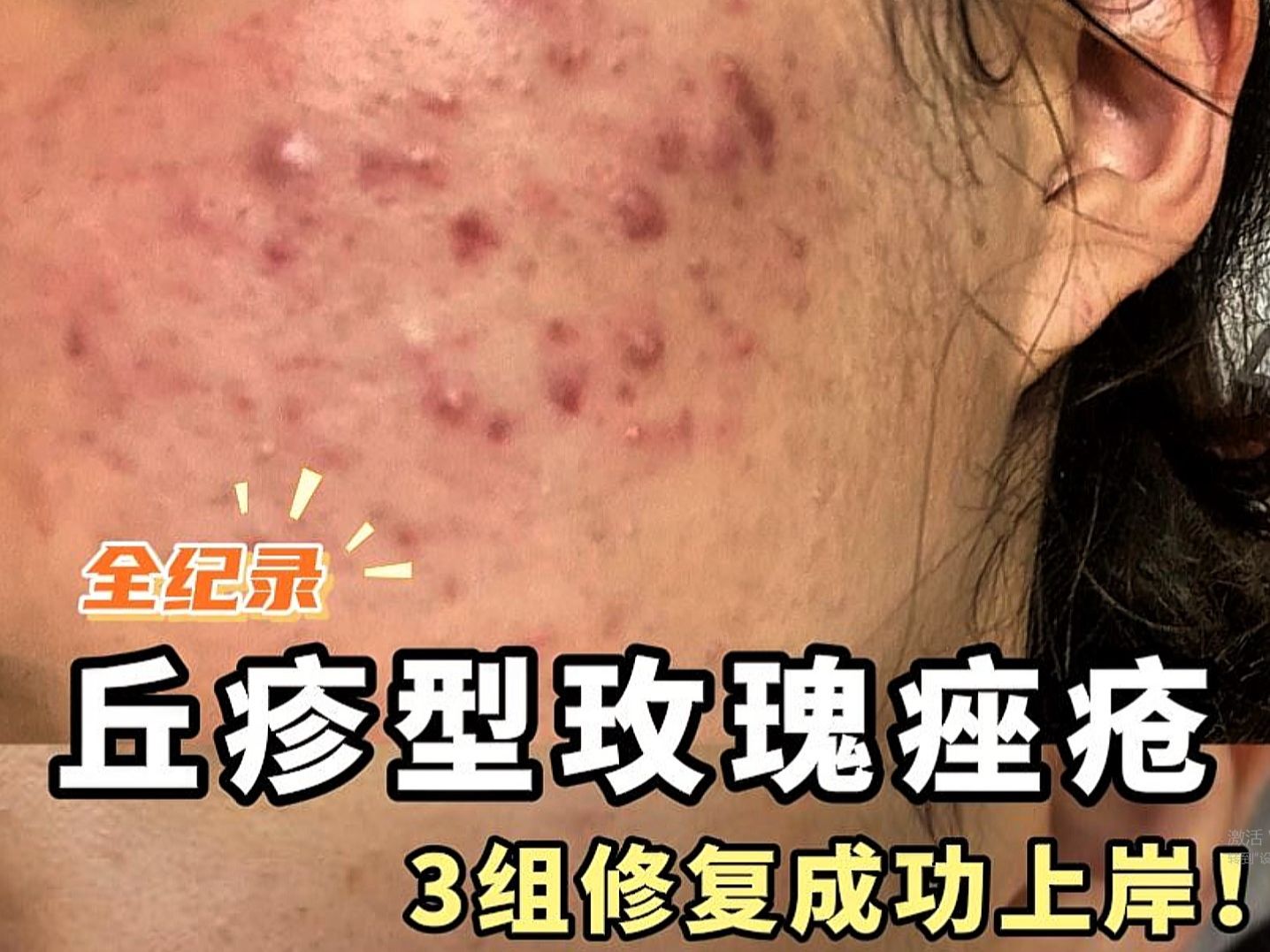 丘疹性痤疮是什么