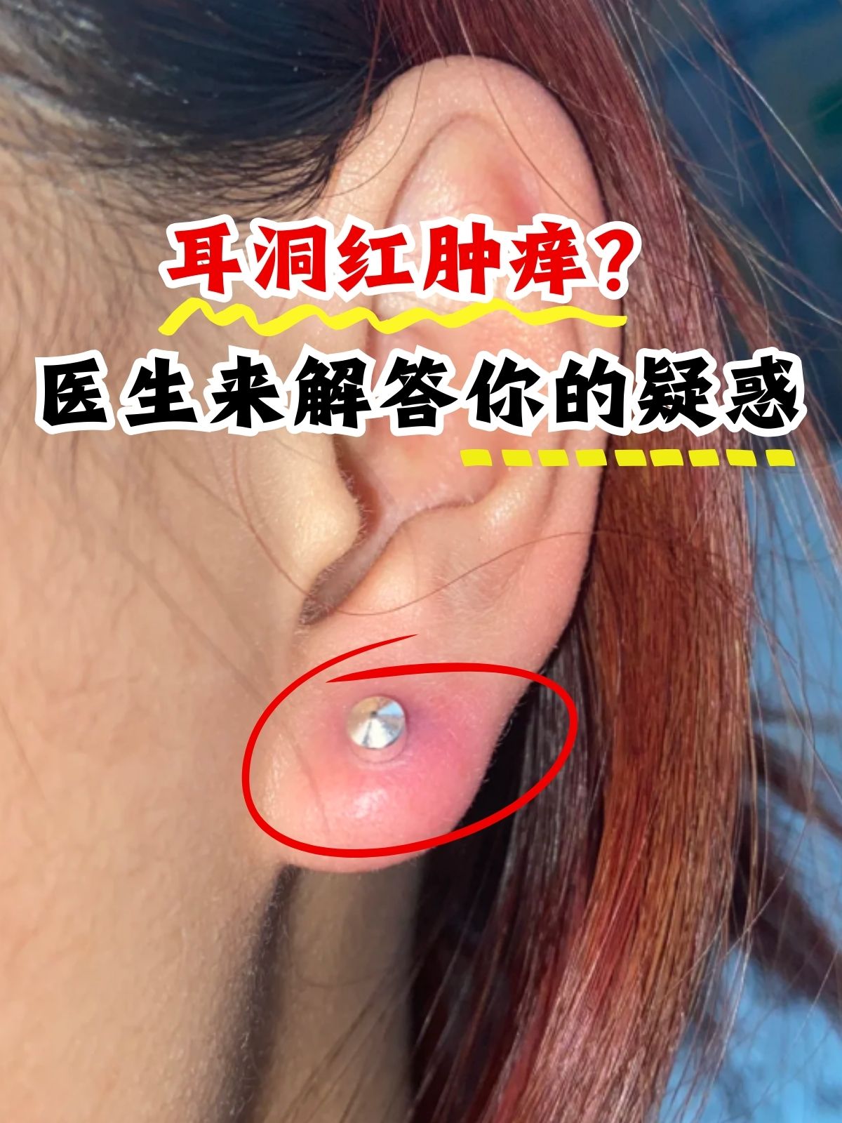 耳洞流血了怎么办?