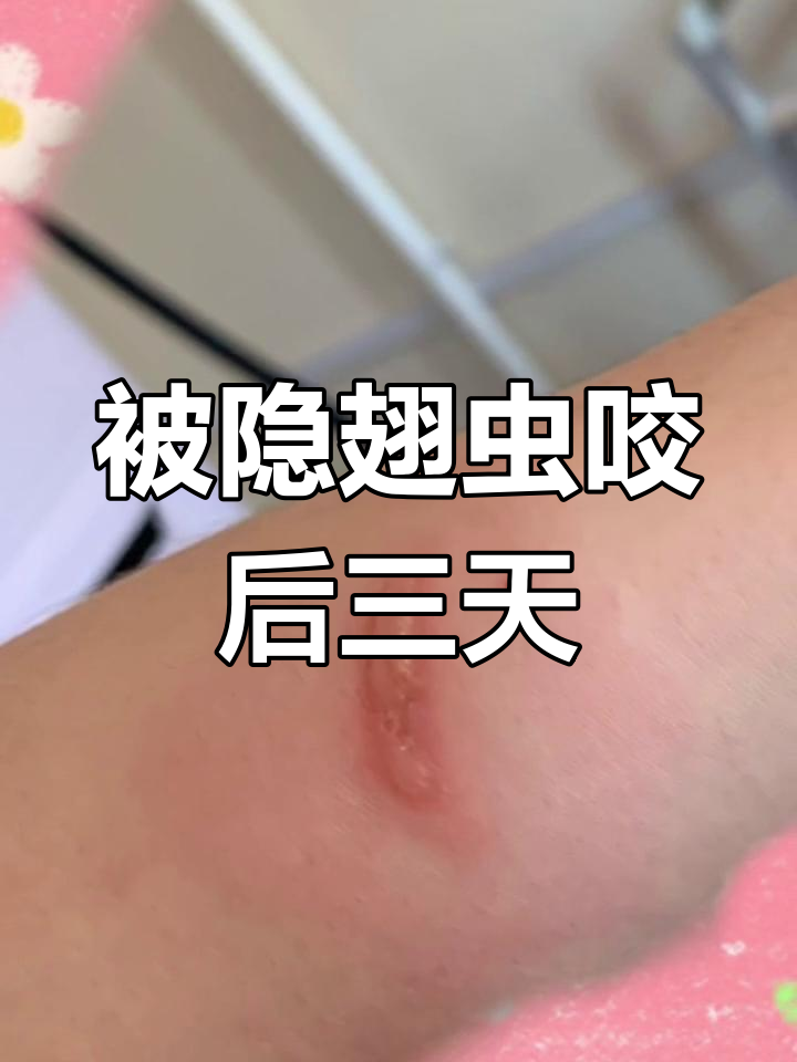 被隐翅虫咬了怎么办....