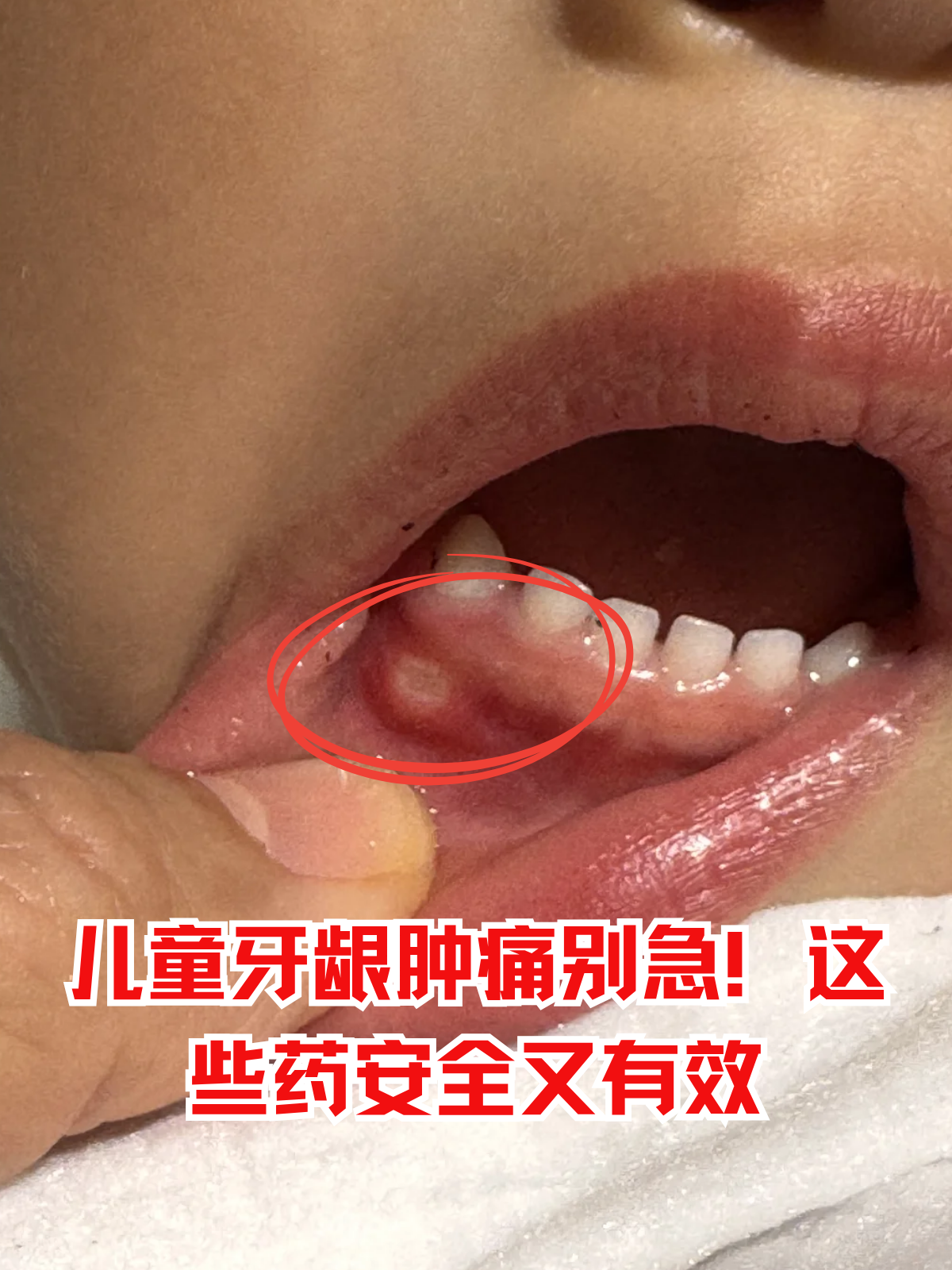 牙龈肿了有什么小偏方..