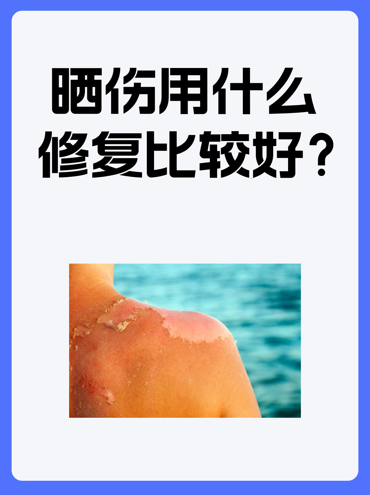 皮肤严重晒伤怎么办