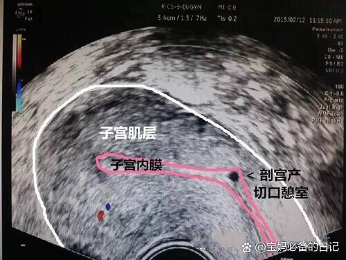 子宫瘢痕憩室是什么病