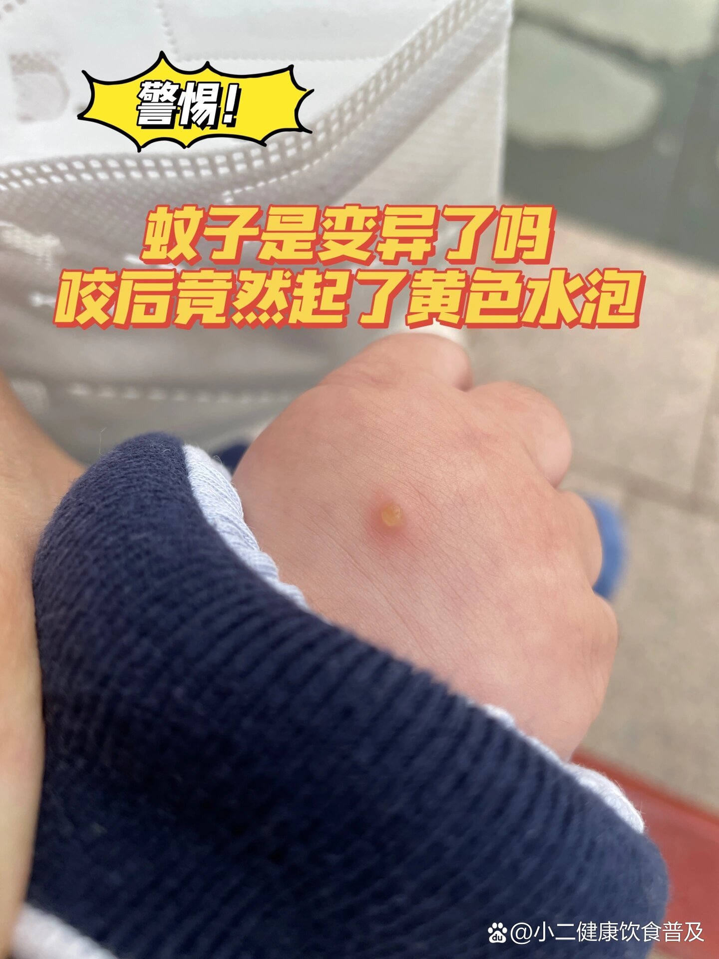 被蚊子咬了起水泡