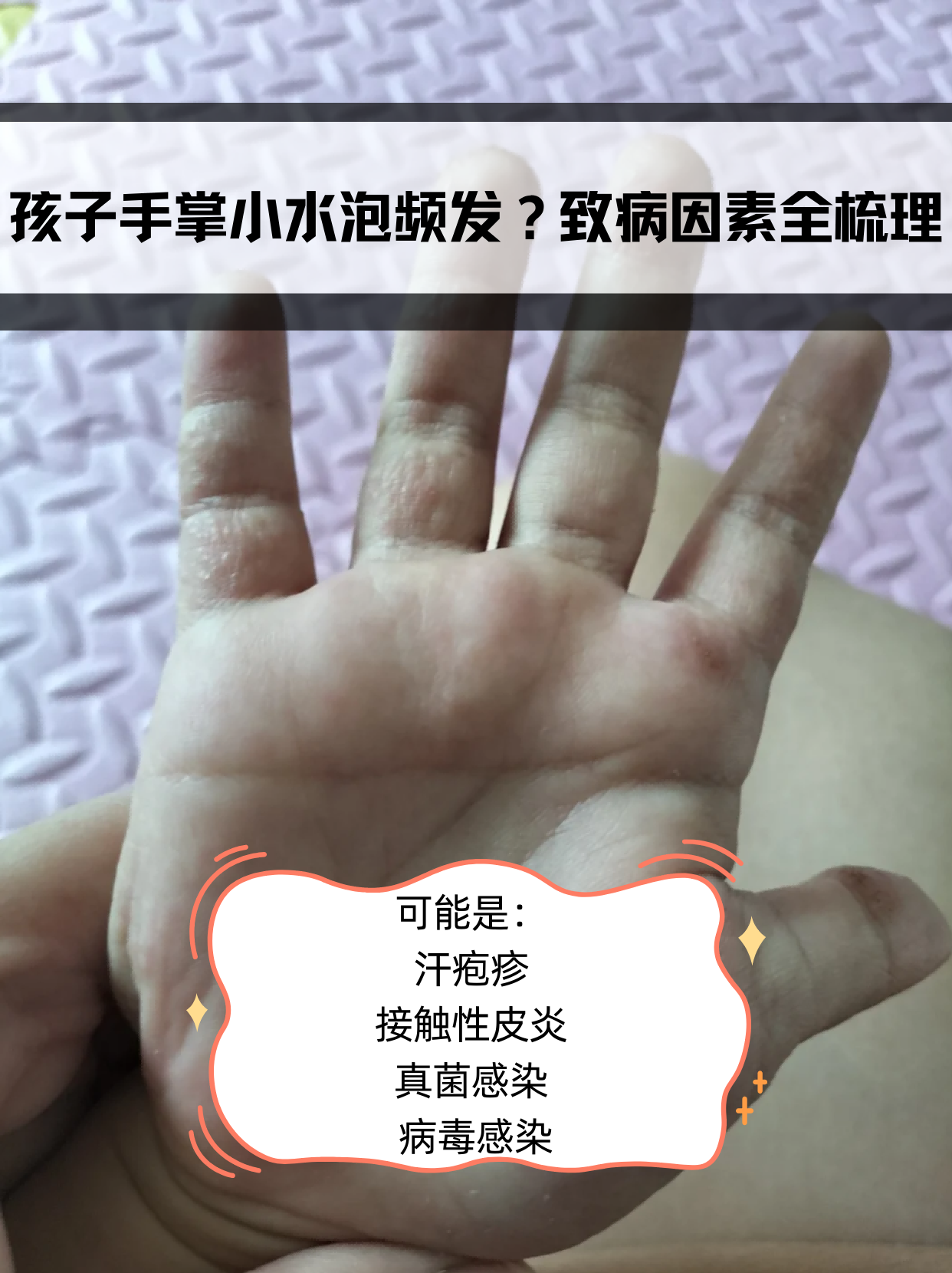 手上起水痘怎么回事?