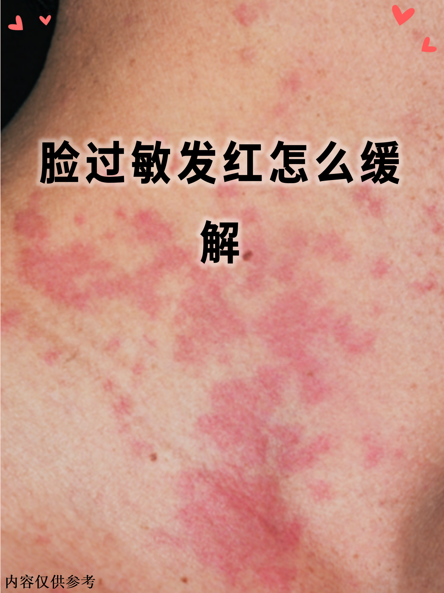 冬天脸发红发烫怎么回事