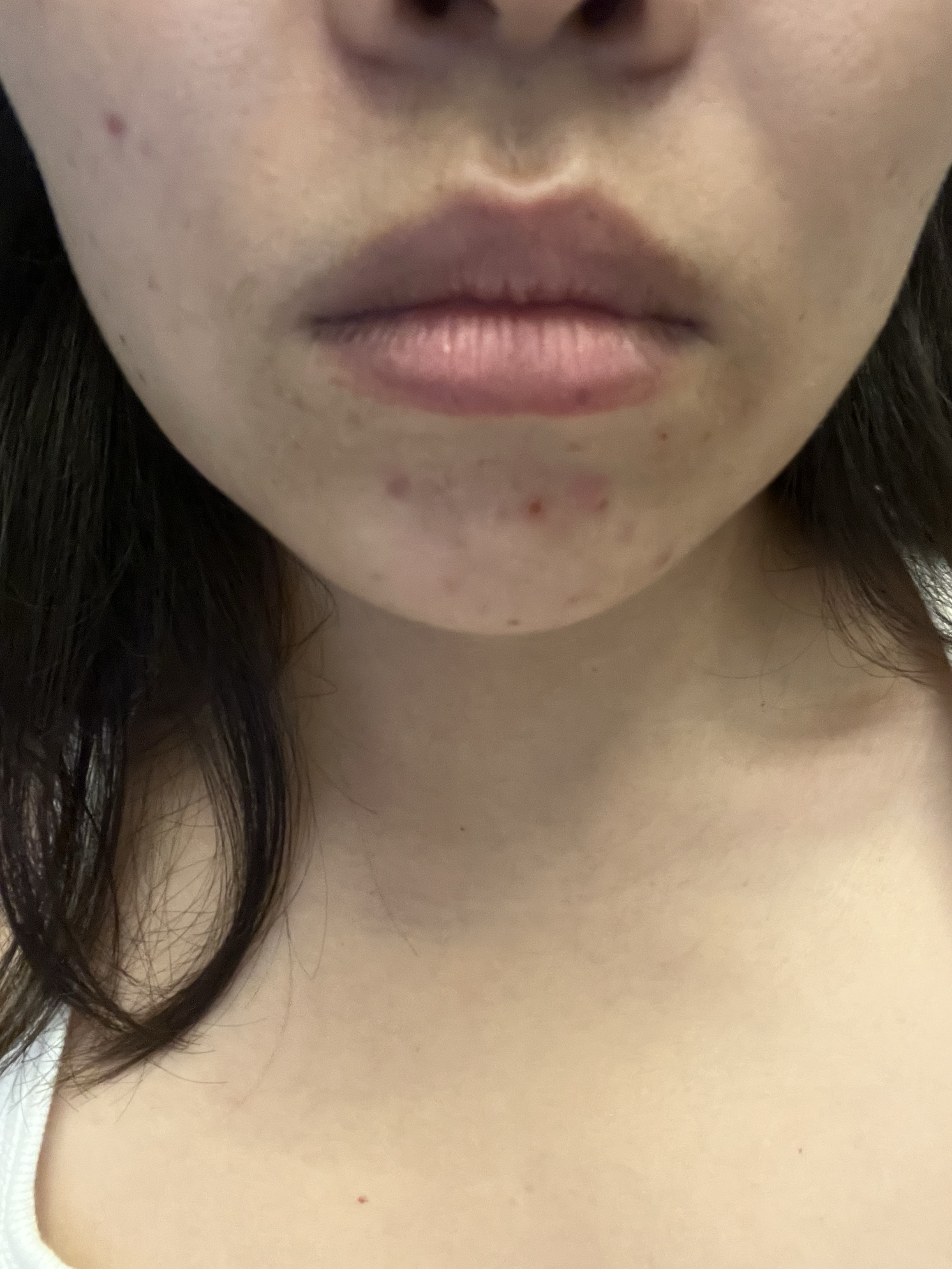 嘴角两边长痘是怎么回事