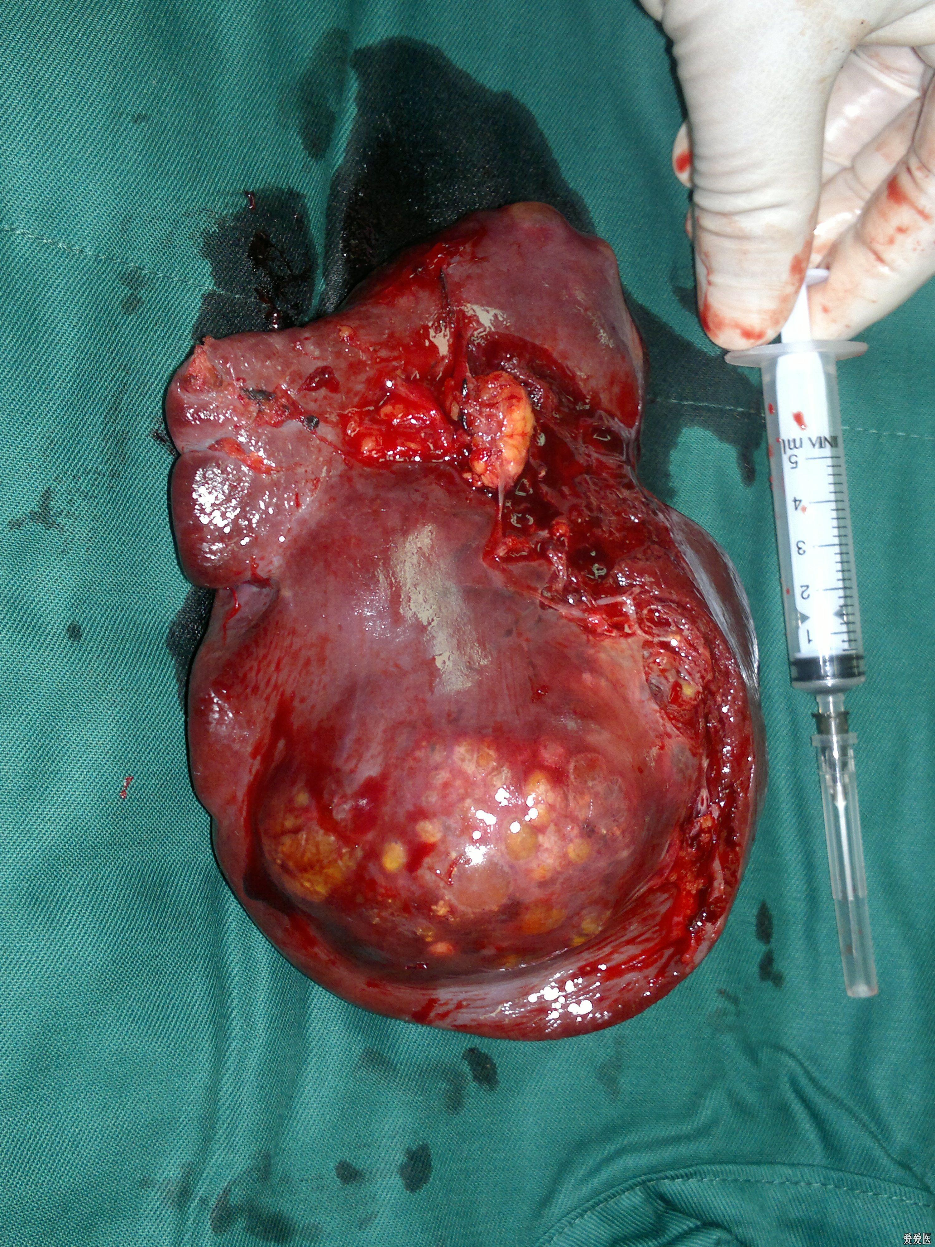 脾切除后还能活多久?