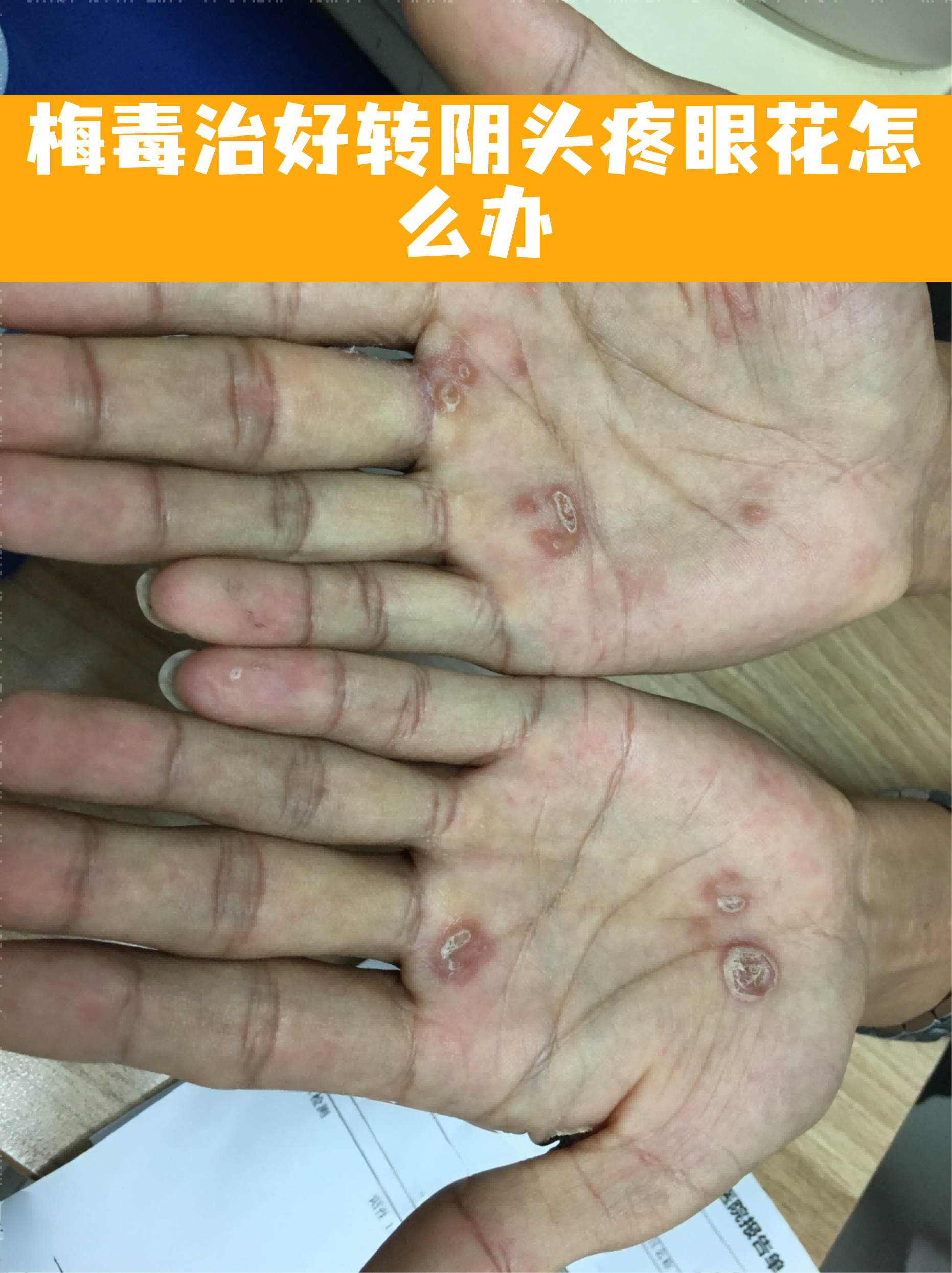 梅毒转阴还会复发吗