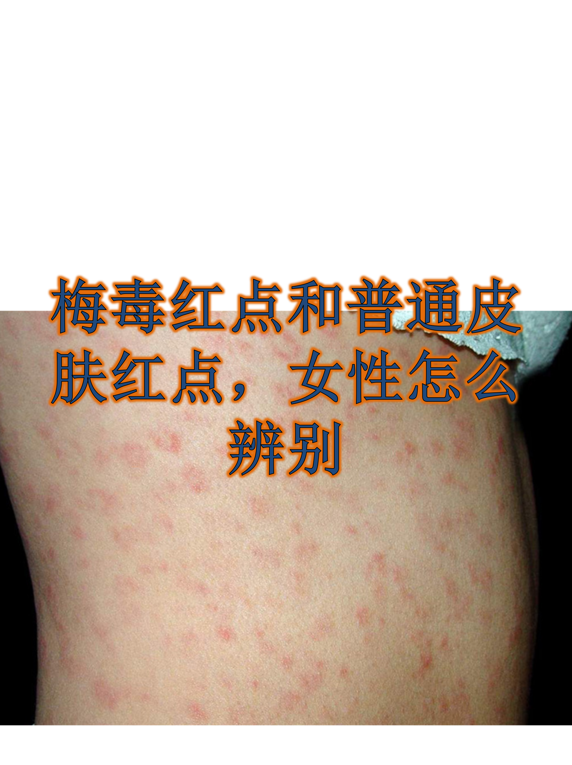 梅毒转阴还会复发吗