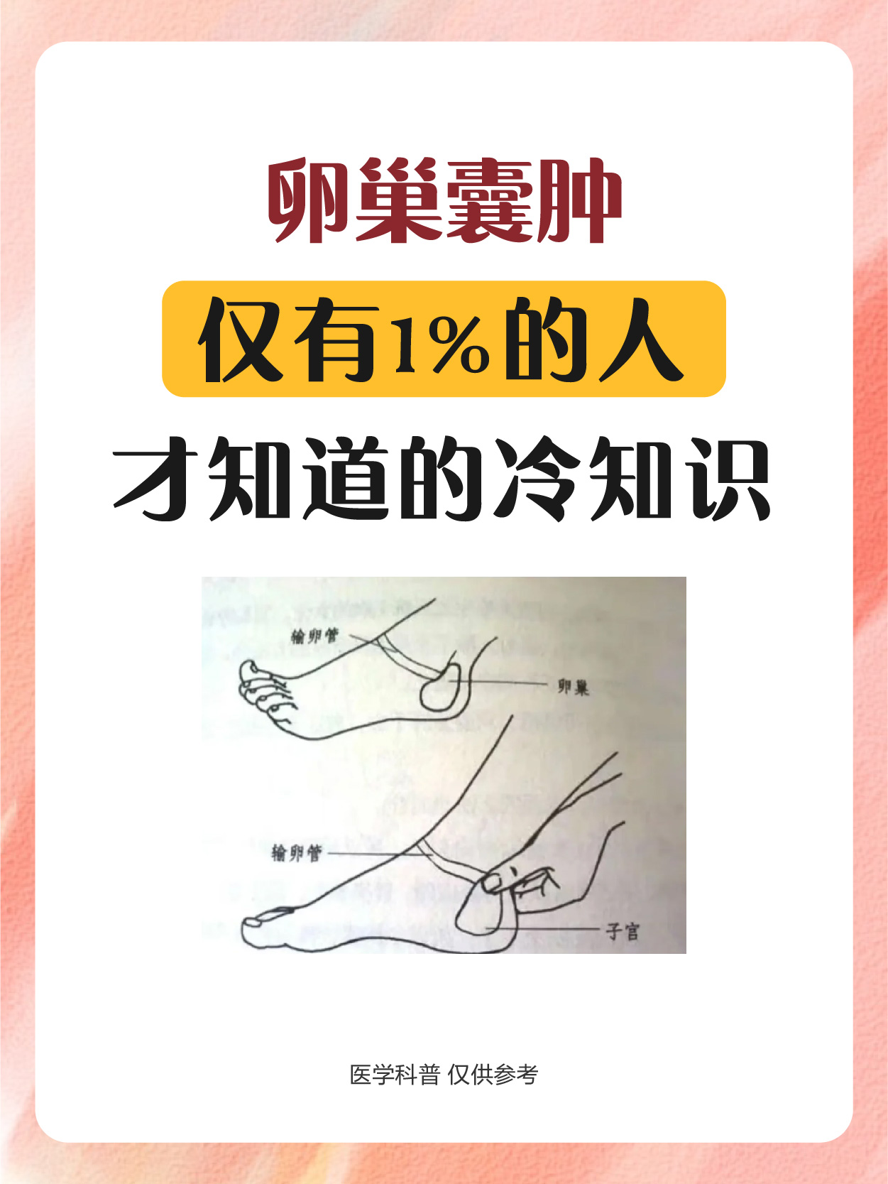 什么是卵巢巧克力囊肿