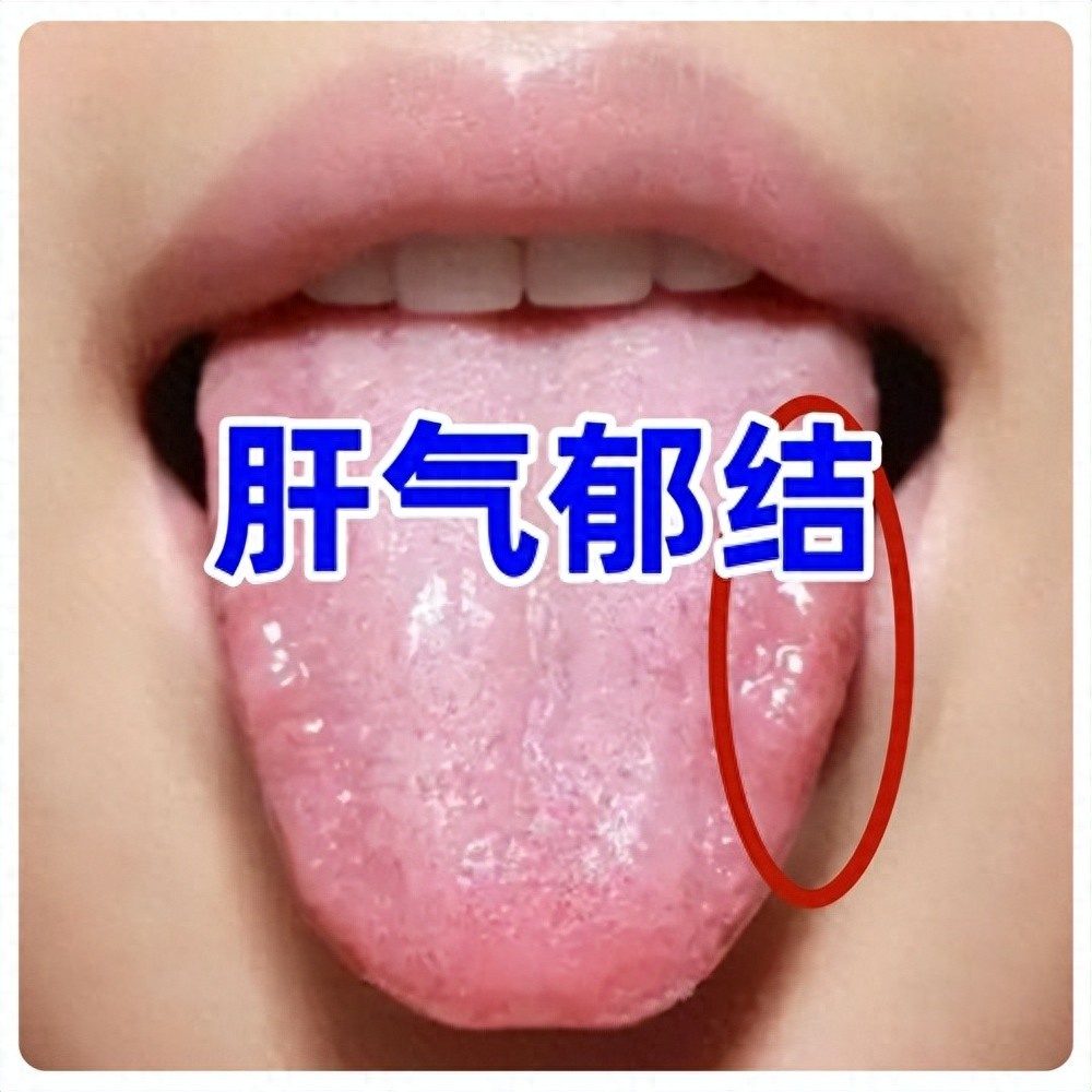 肝气郁结的症状