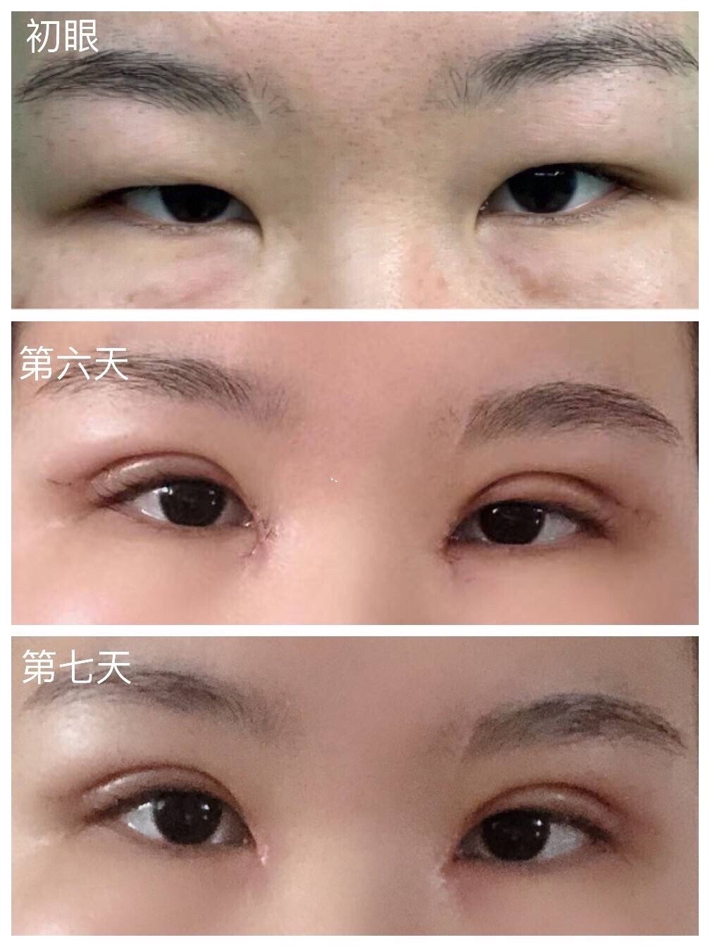 割完双眼皮多久消肿