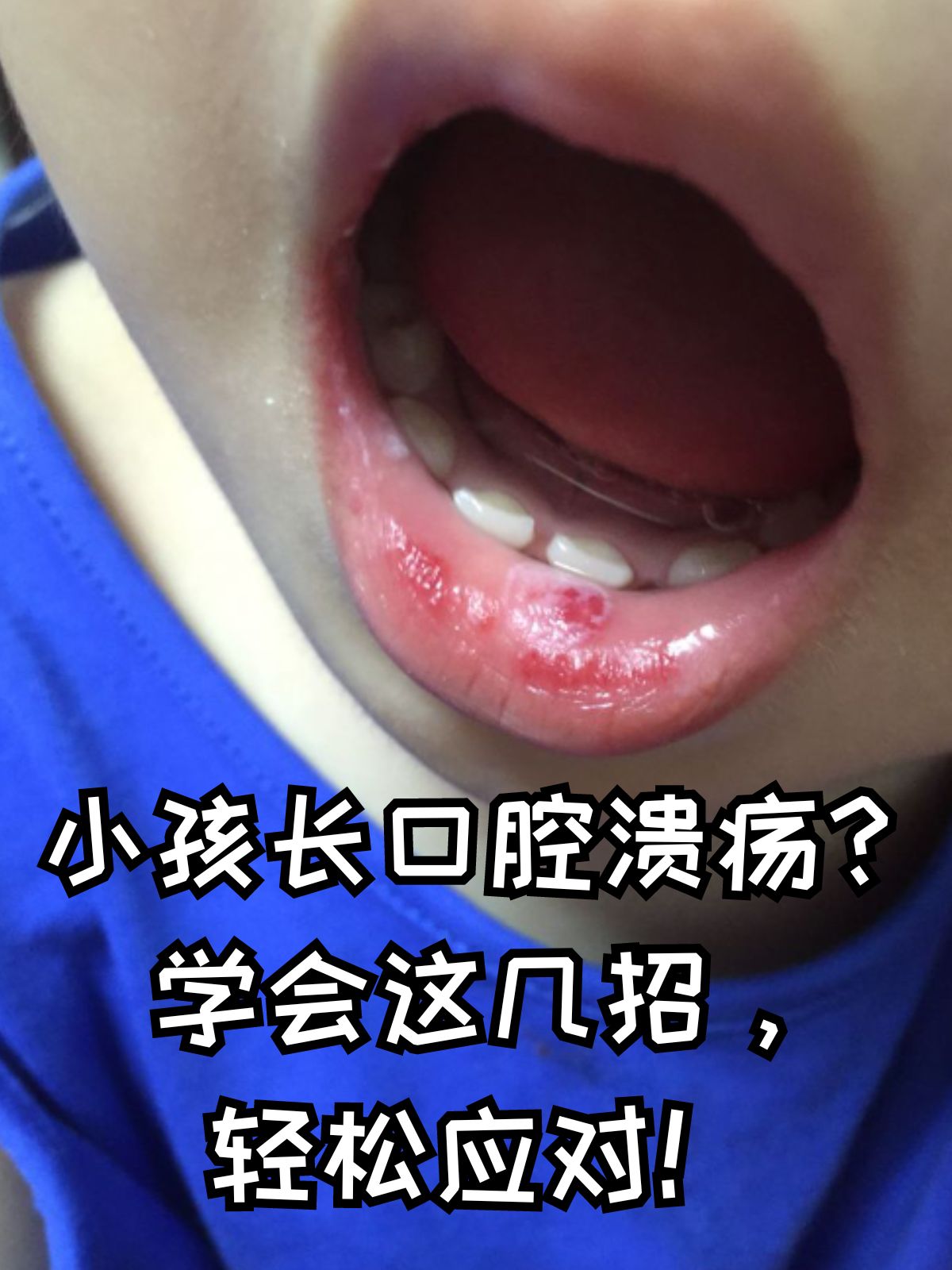 嘴里长口腔溃疡怎么办