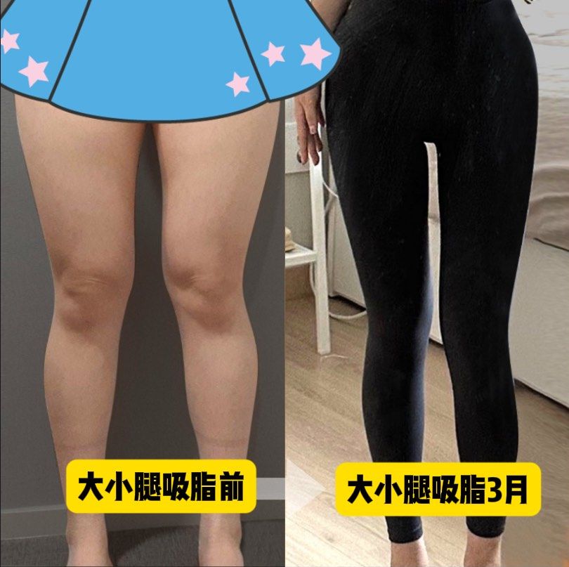 腿部吸脂大概需要多少钱呢?