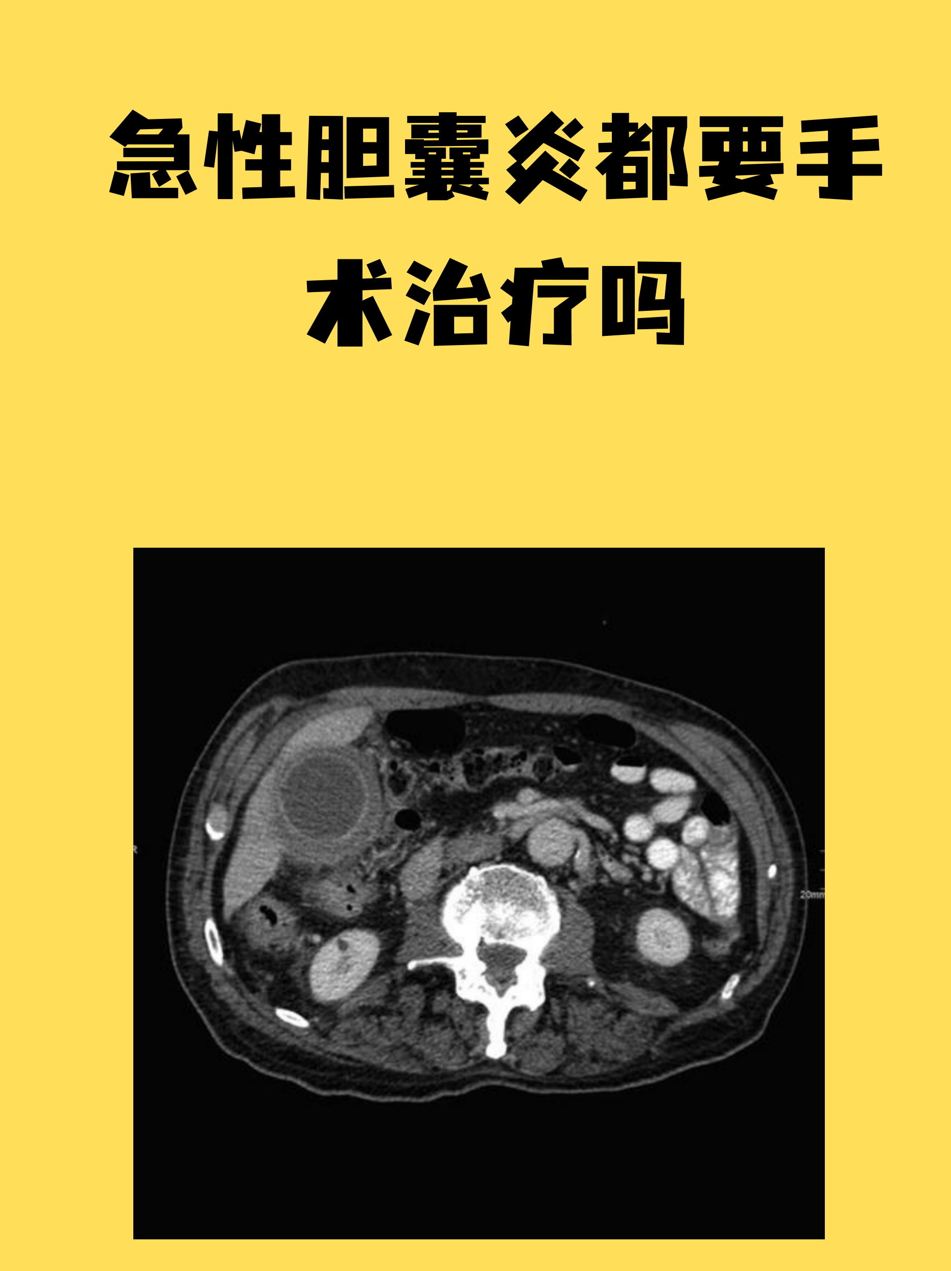 急性胆囊炎严重吗?