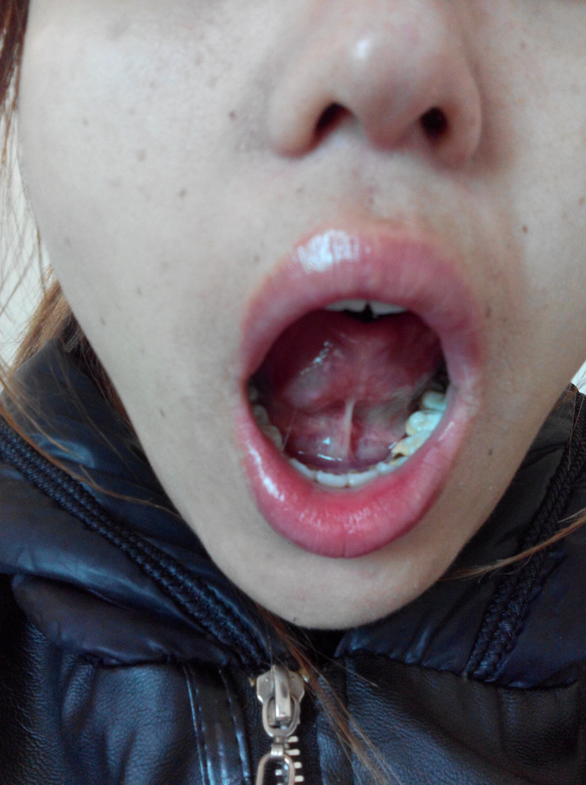 舌头下面长肉芽是什么东西