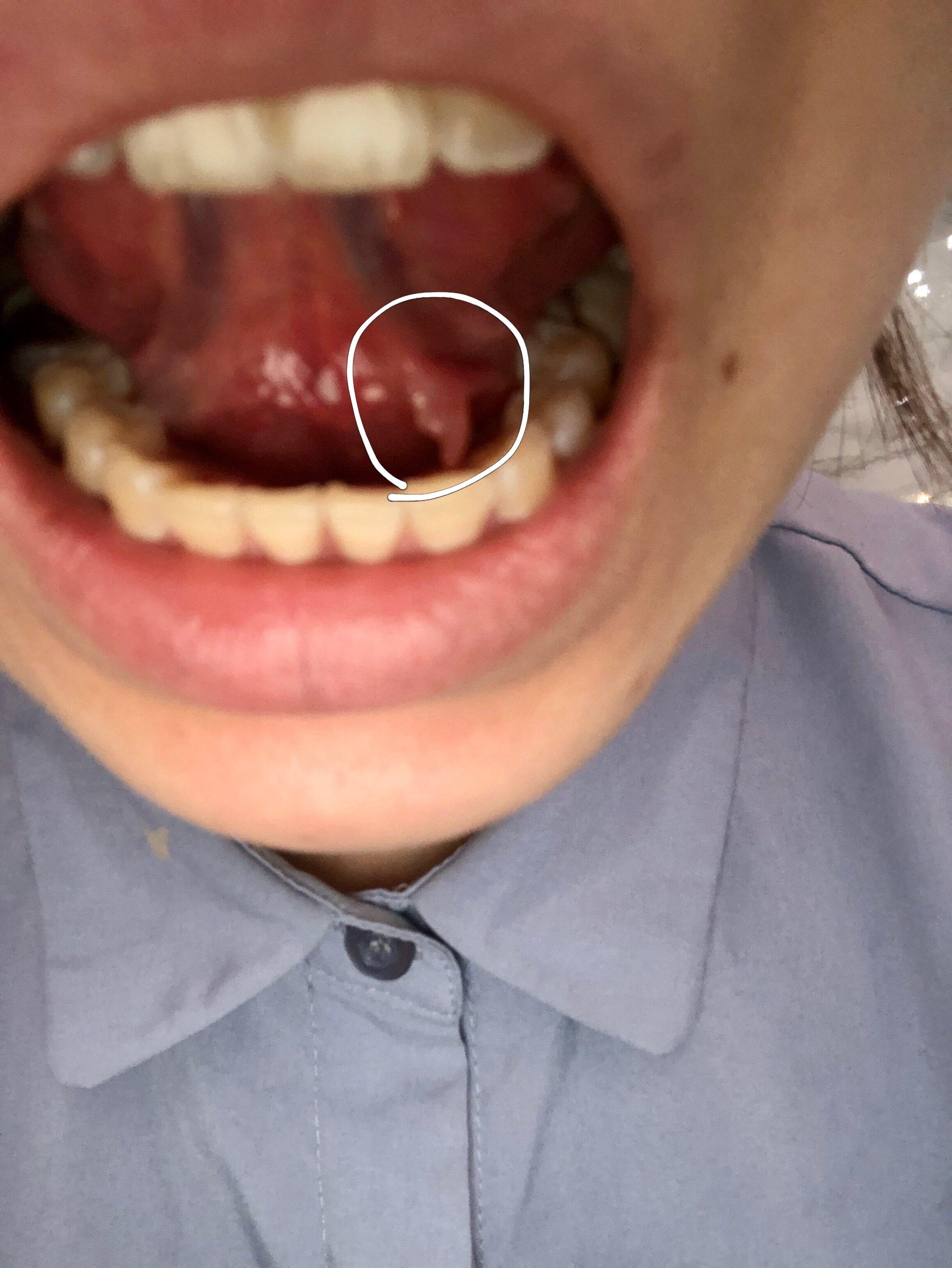 舌头下面长肉芽是什么东西