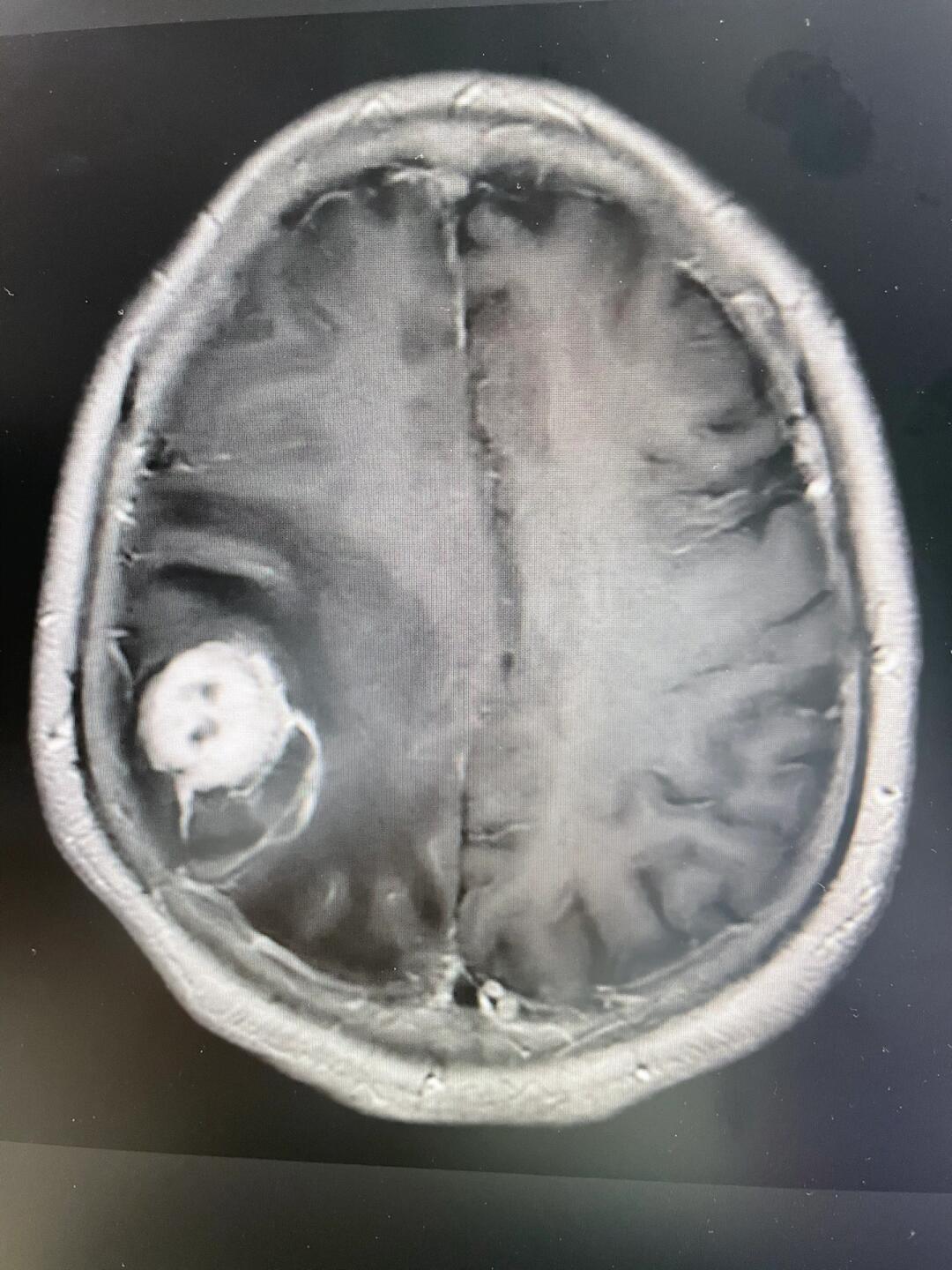 肺癌脑转移有哪些症状表现?