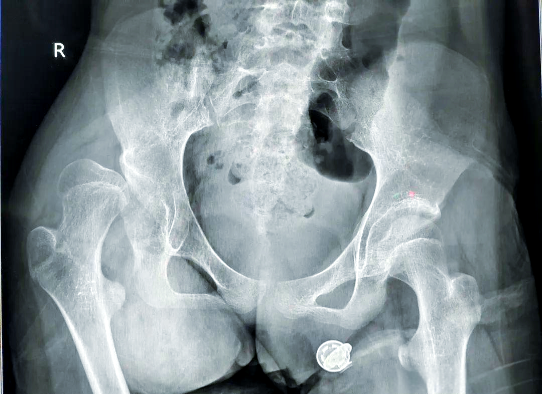 婴儿髋关节脱位的表现有哪些