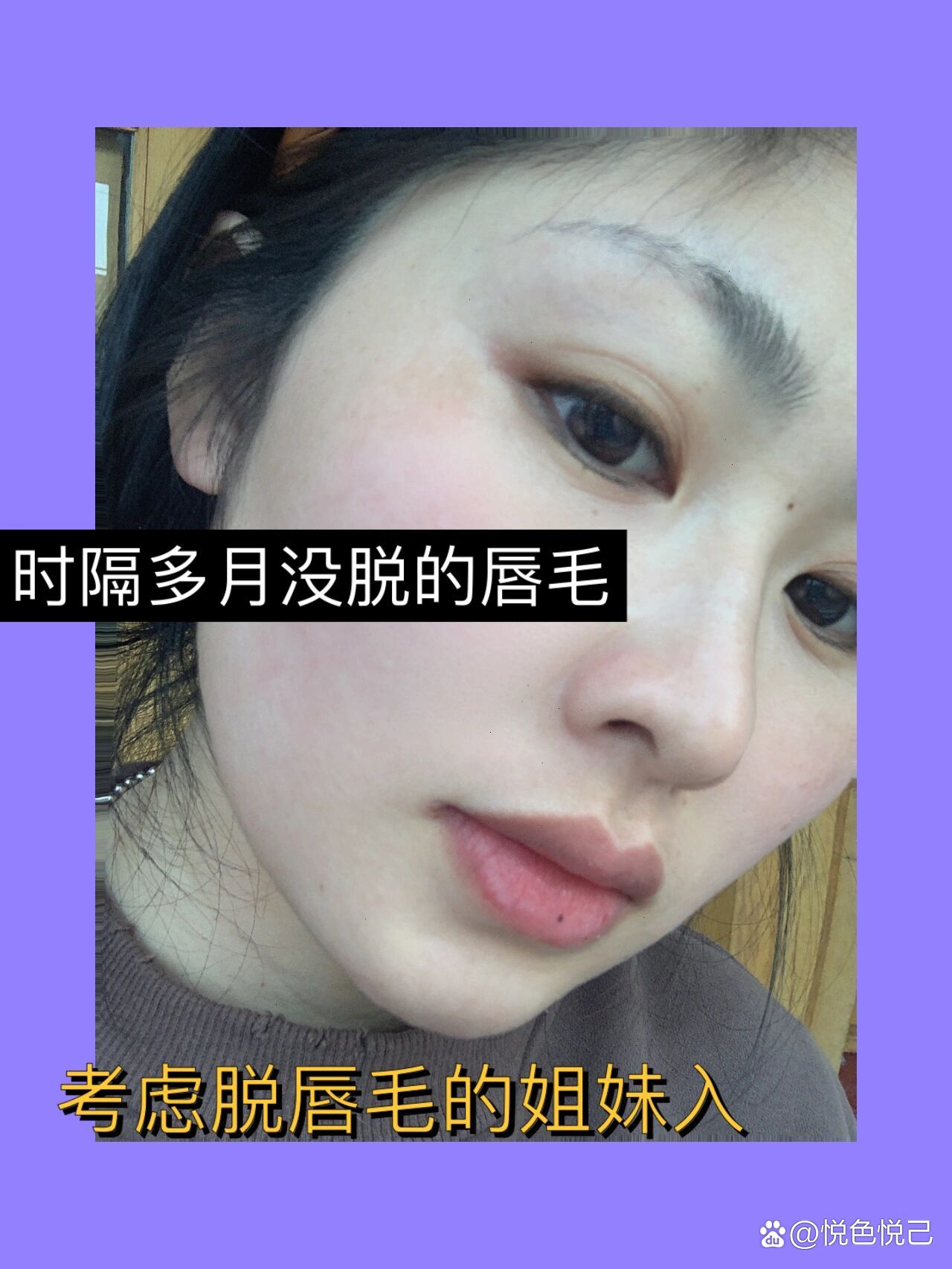 脱唇毛要多少钱