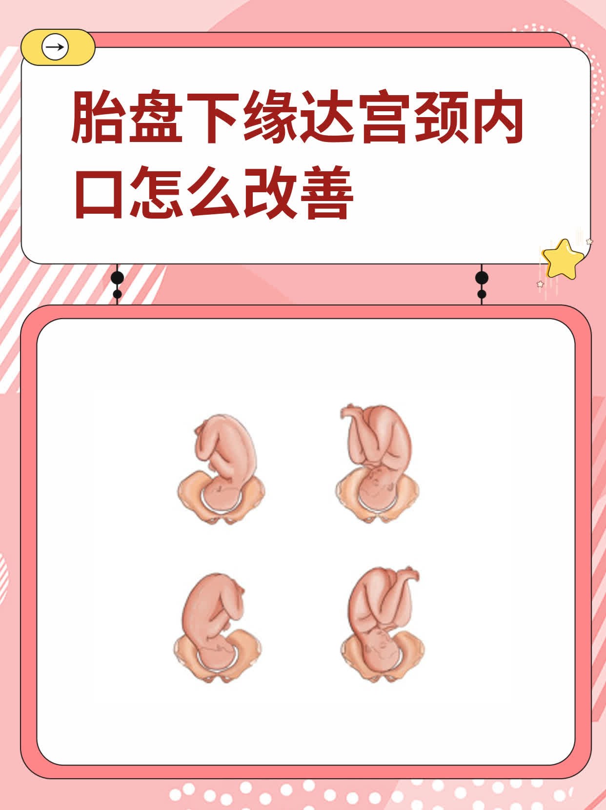 宫底胎盘是什么意思