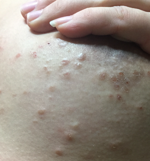 乳晕上长了小肉粒