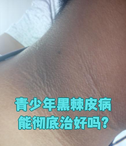 黑棘皮病能彻底治好吗