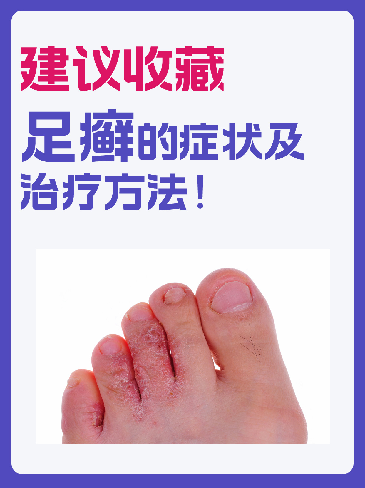 脚癣怎么根治