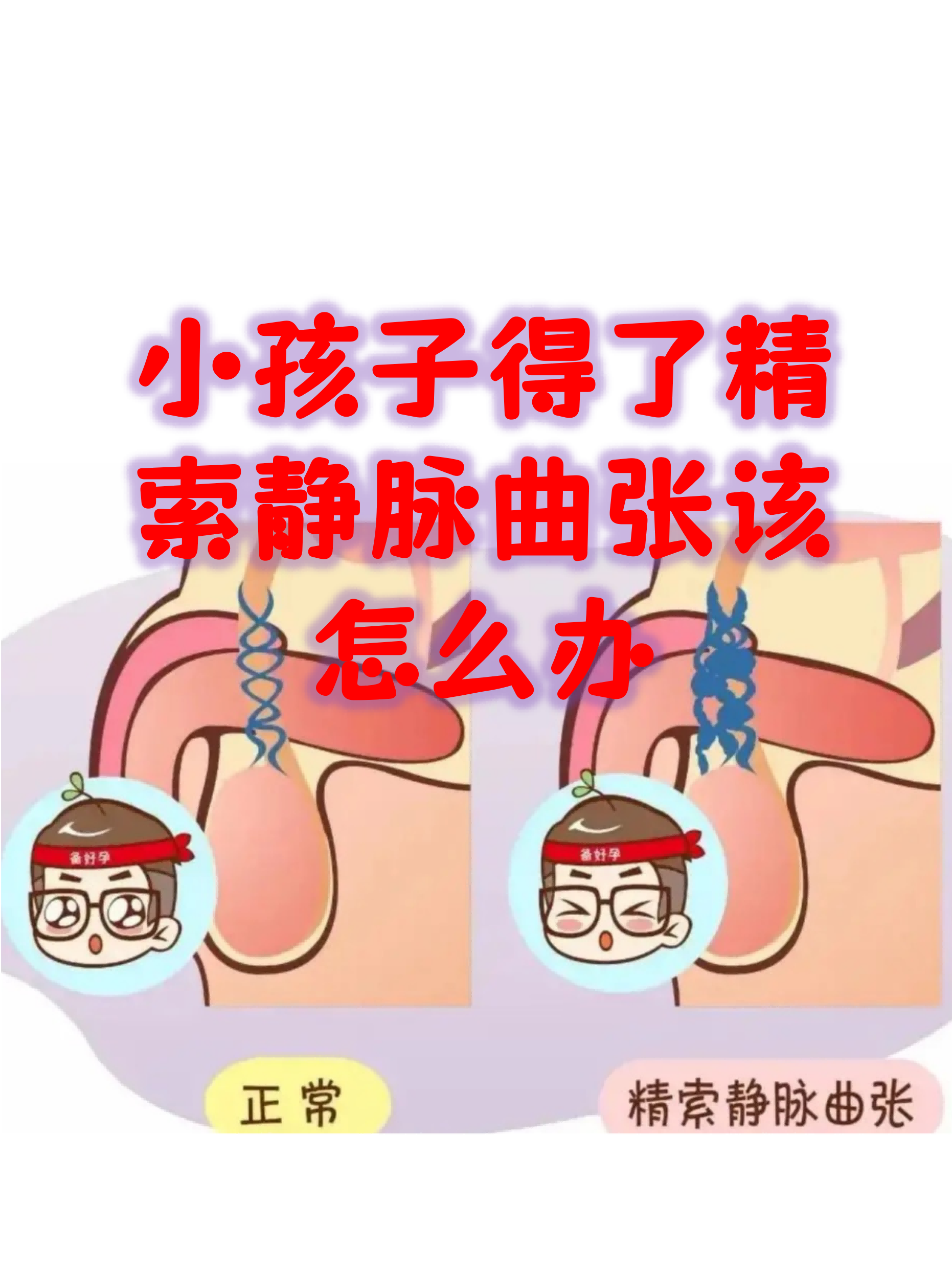 得了精索静脉曲张要怎么办