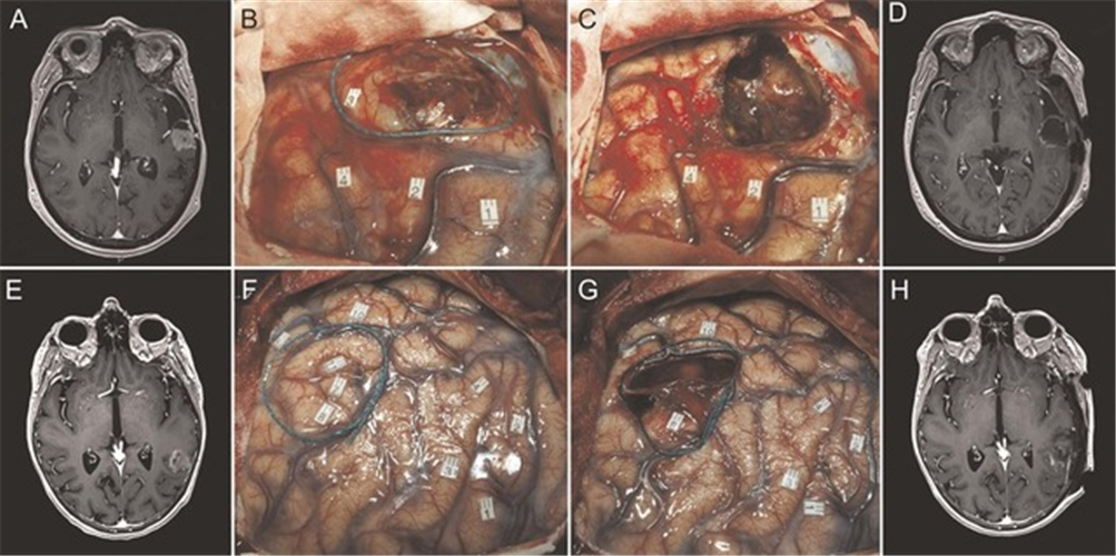 胶质瘤是怎么回事?