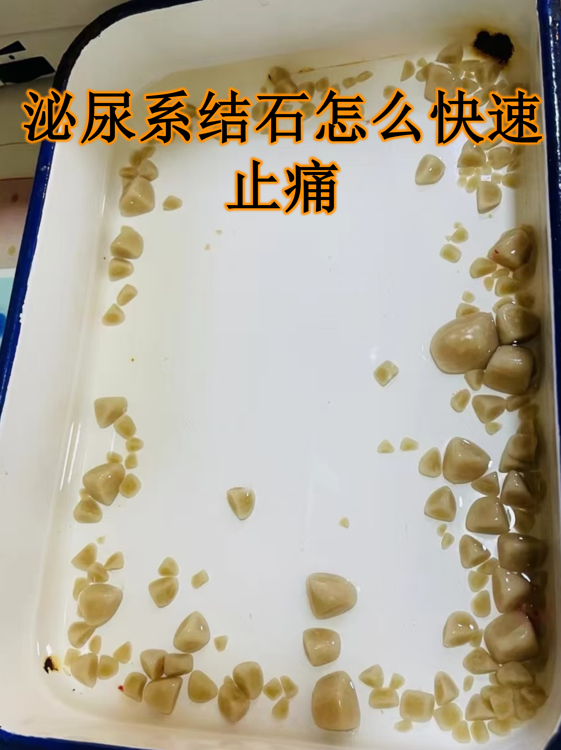 如何才能让肾结石不痛