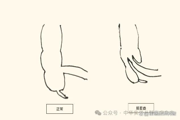 婴儿肠套叠的早期症状